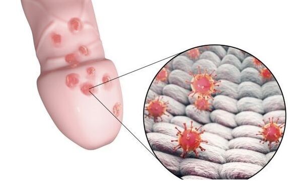 allergia peenise suurendamise geelile