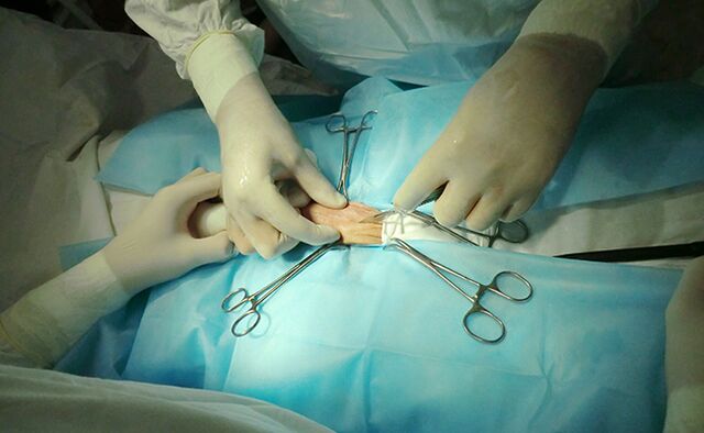 Reproduktiivorgani operatsioon aitab selle suurust suurendada