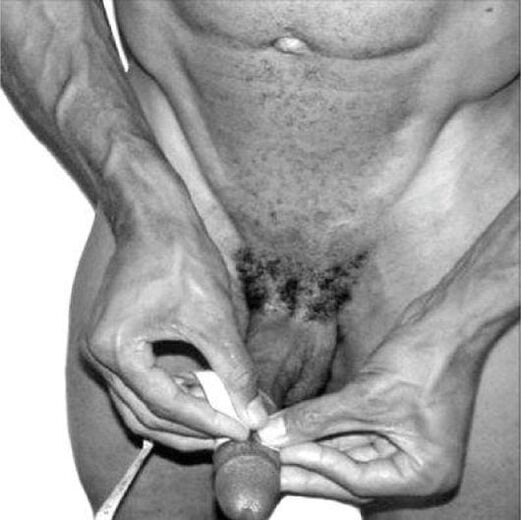 peenise mõõtmine enne laienemist